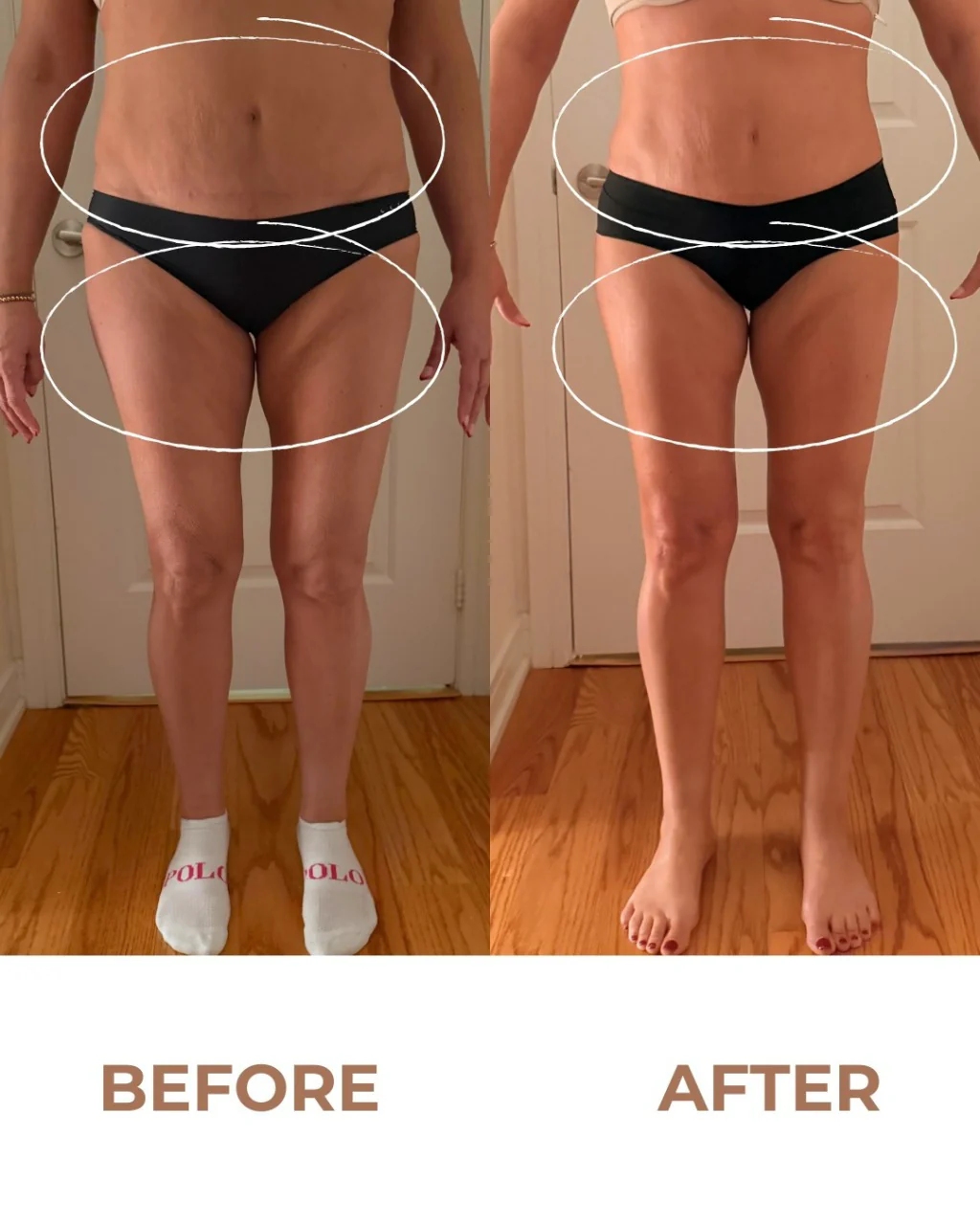Body Contouring — after
