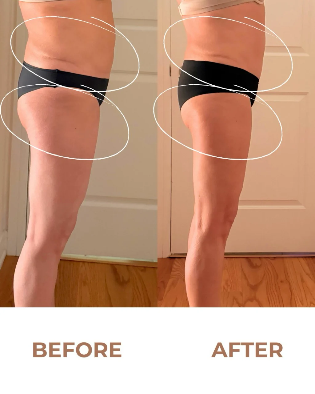 Body Contouring — before